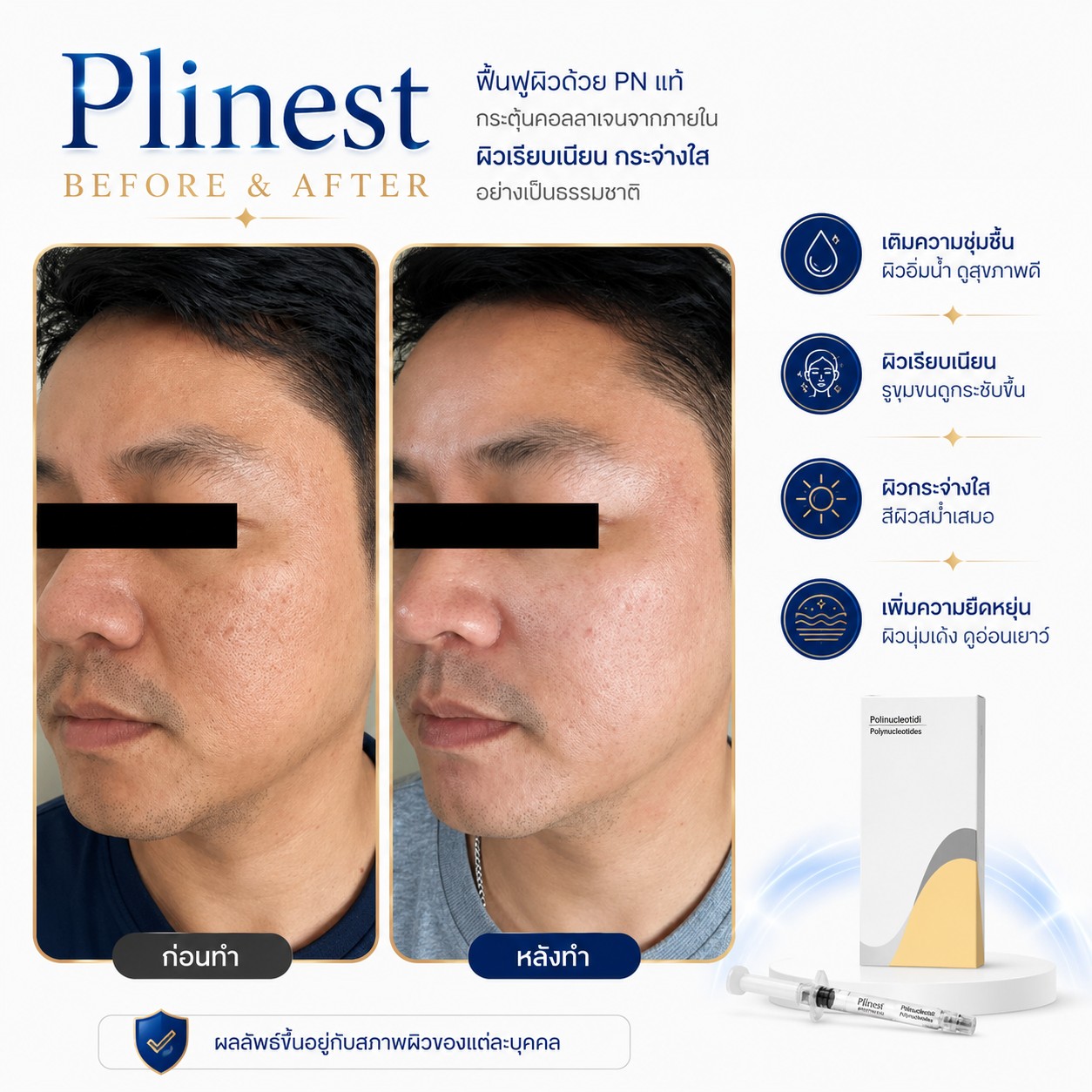 รีวิว Plinest ดีไหม