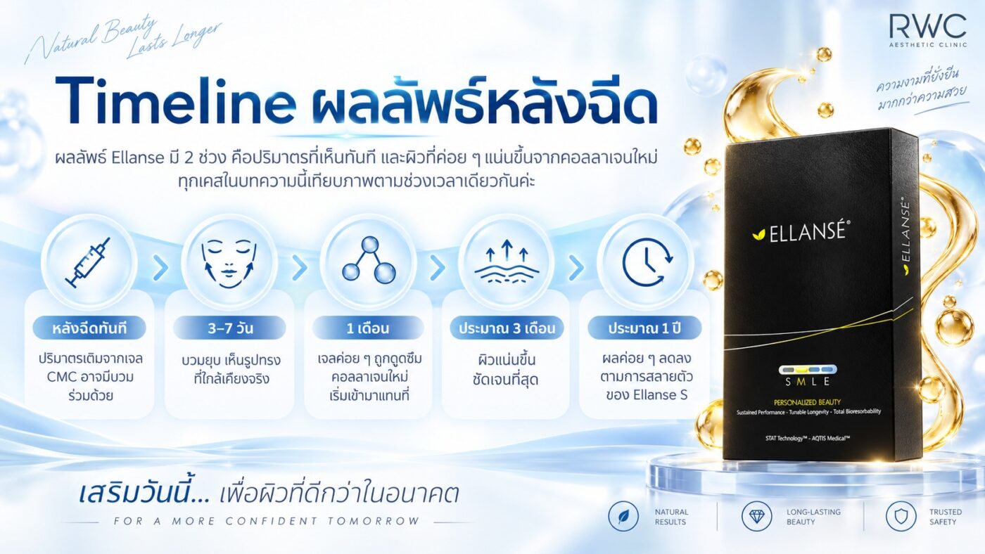 ผลลัพธ์หลังฉีด Ellanse