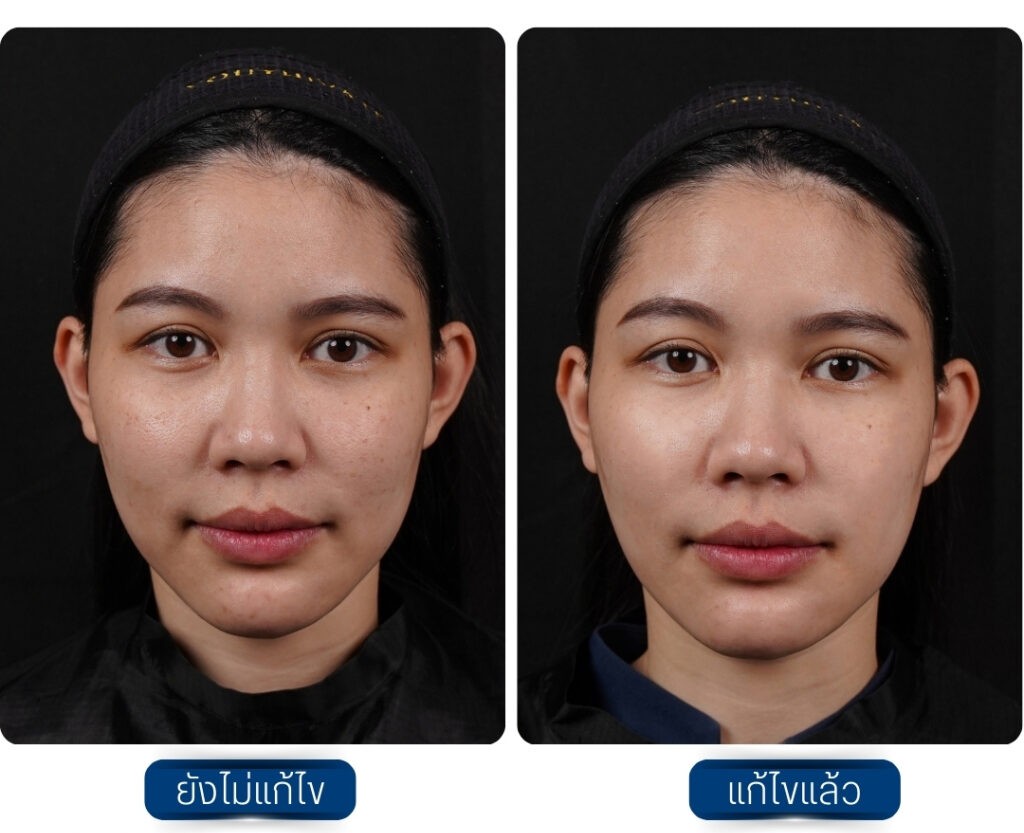 ฉีด Sculptra รีวิว