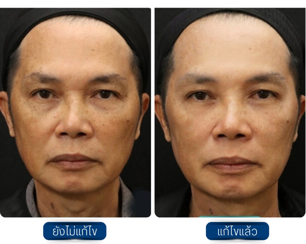รีวิว Sculptra