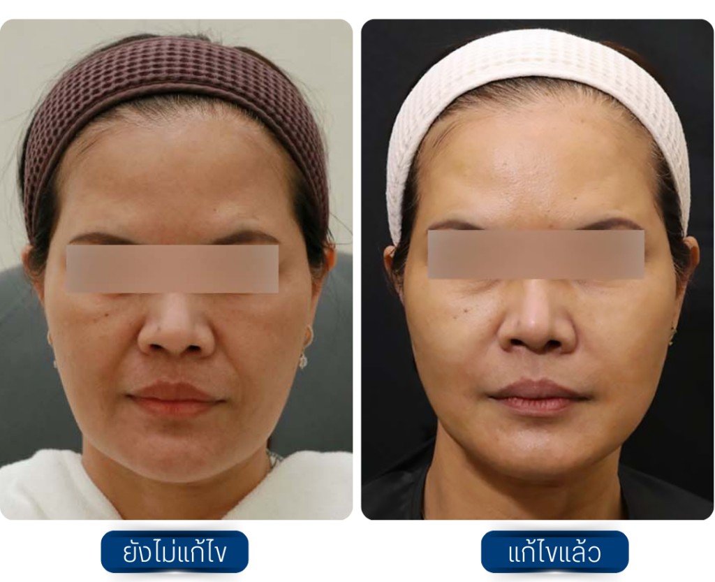 รีวิวฉีด Sculptra