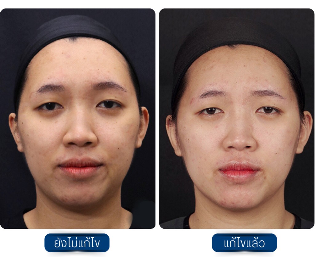 Sculptra รีวิว