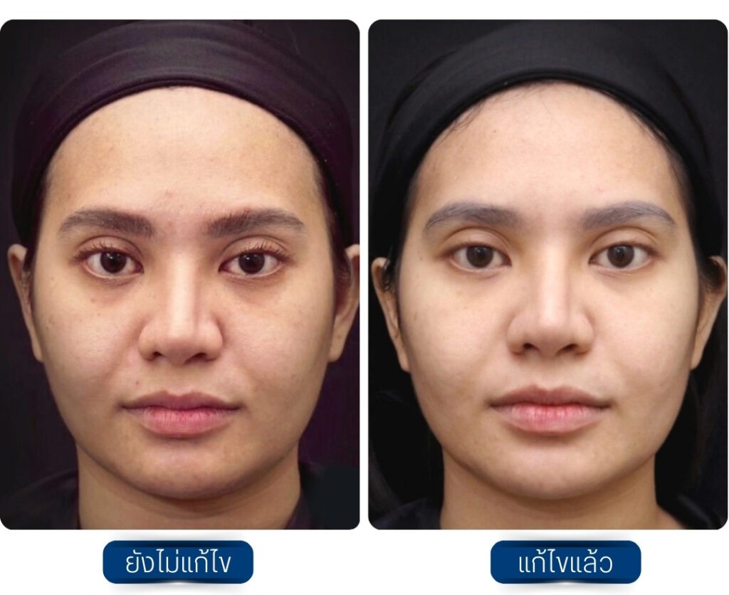 ฉีด Sculptra รีวิวก่อนหลัง