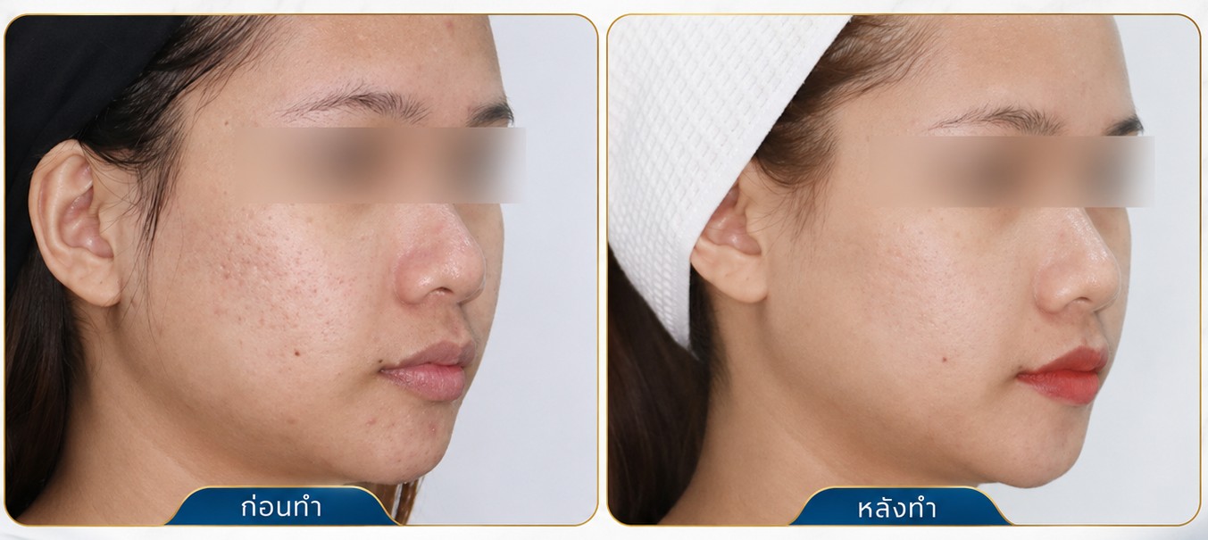 Fractora รีวิว