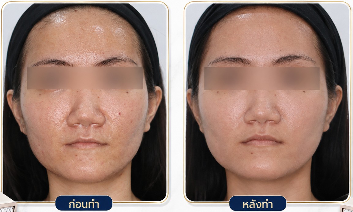 รีวิว ก่อนหลัง Fractora