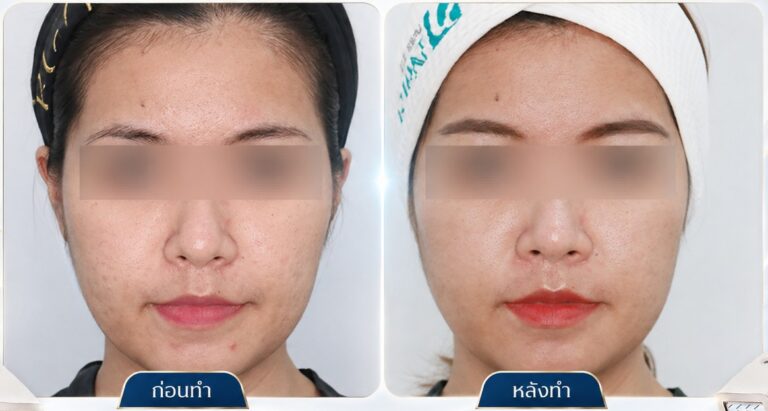 รีวิว Fractora