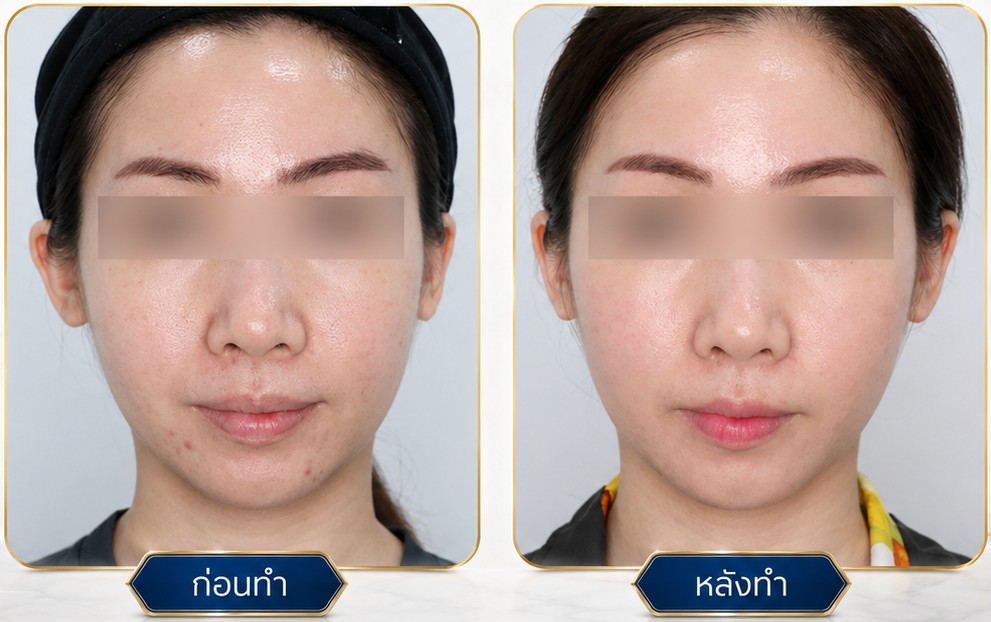 รีวิว ก่อนหลังรักษาหลุมสิว