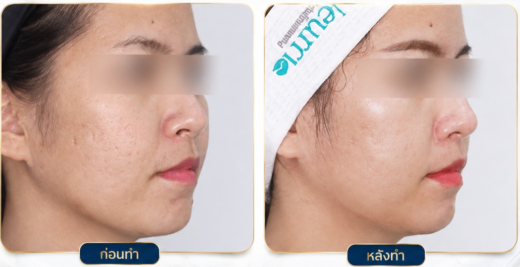 Fractora รีวิวหลังทำ
