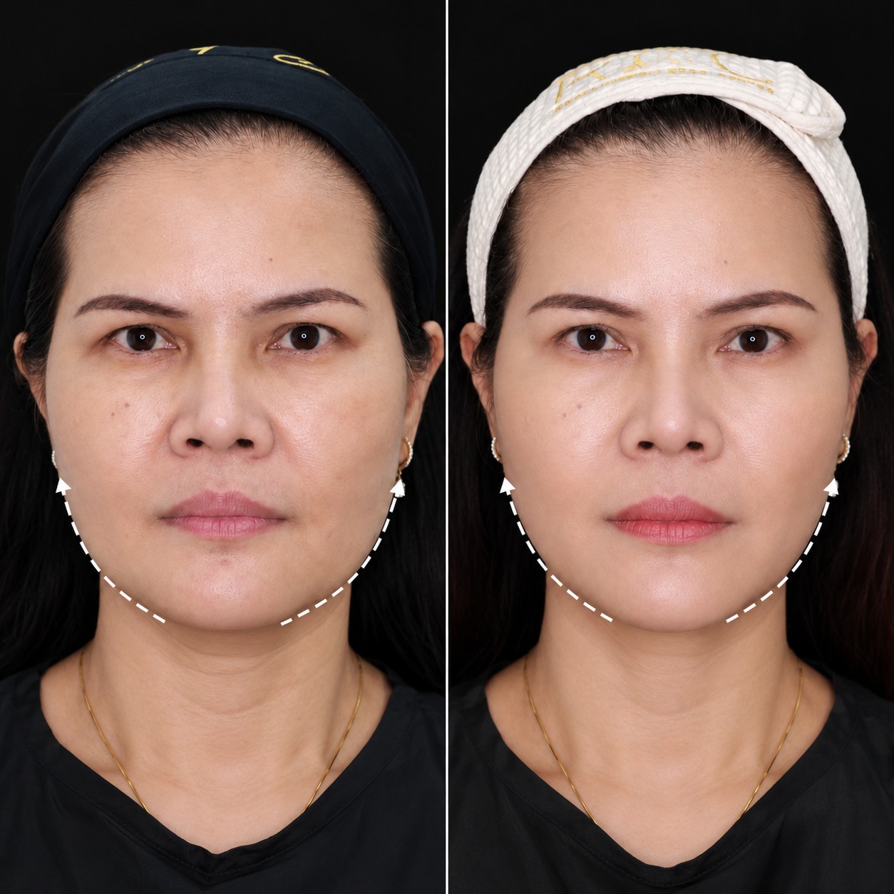 ulthera prime รีวิว