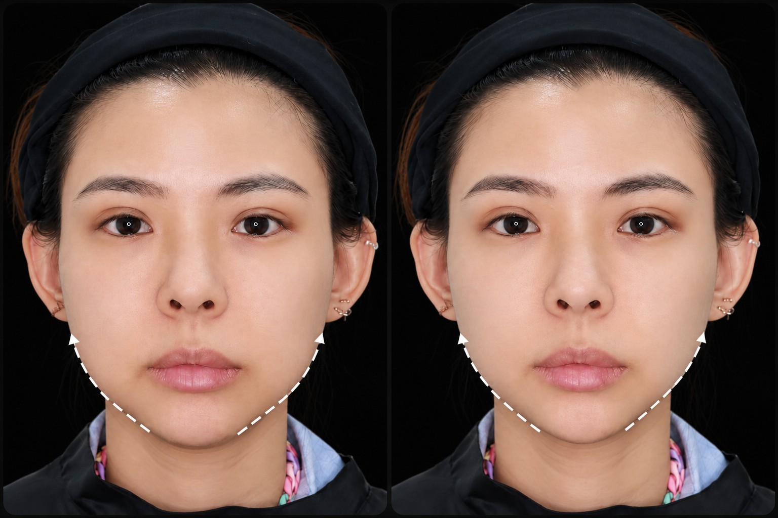 รีวิว ulthera prime
