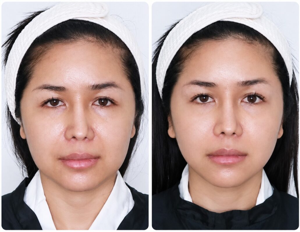 รีวิวหลังทำ Ulthera