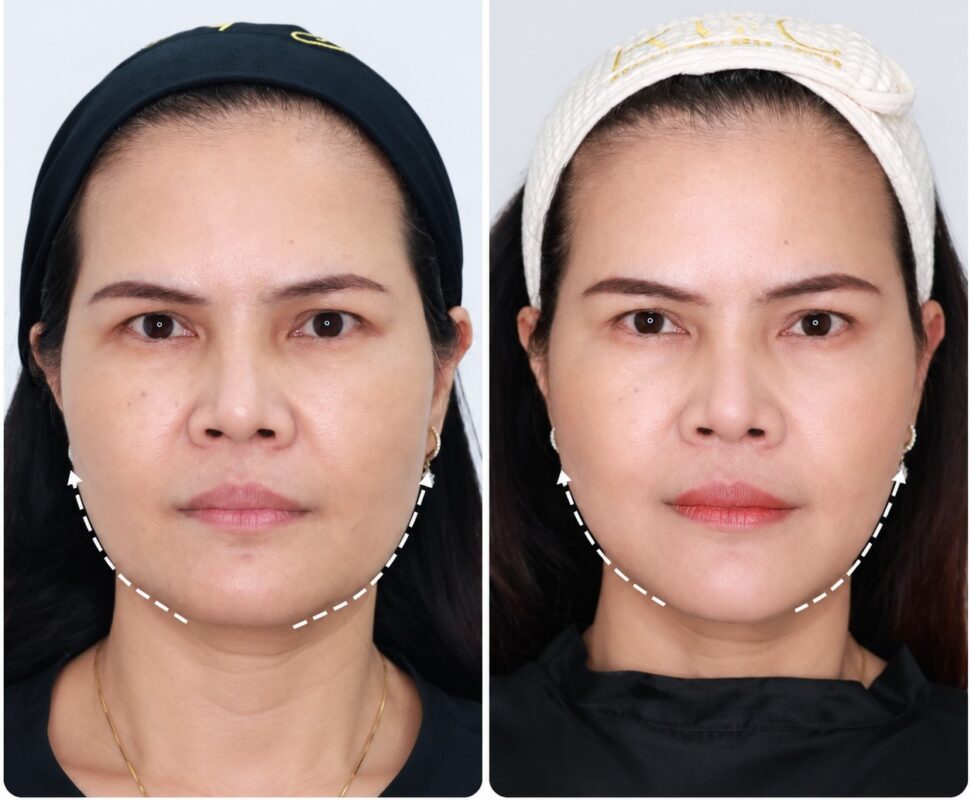 Ulthera รีวิวหลังทำ